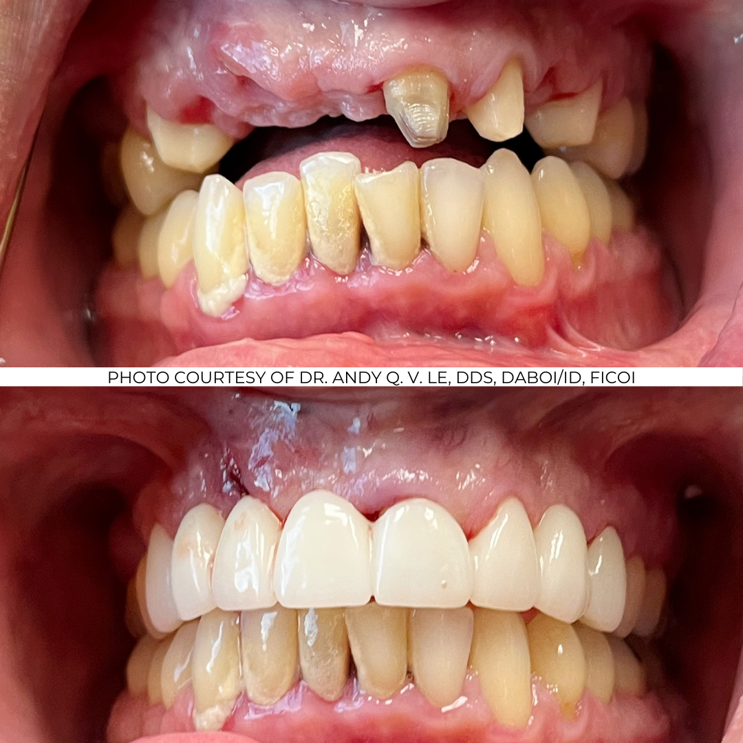 Before and After Implant Pictures