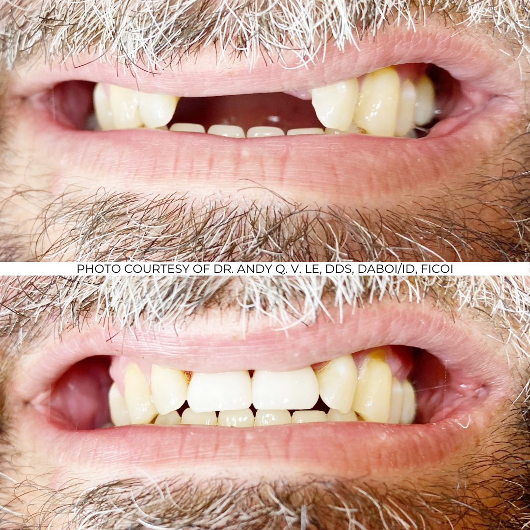Before and After Implant Pictures