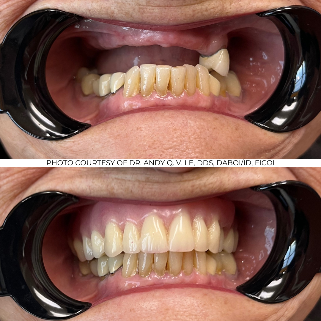 Before and After Implant Pictures