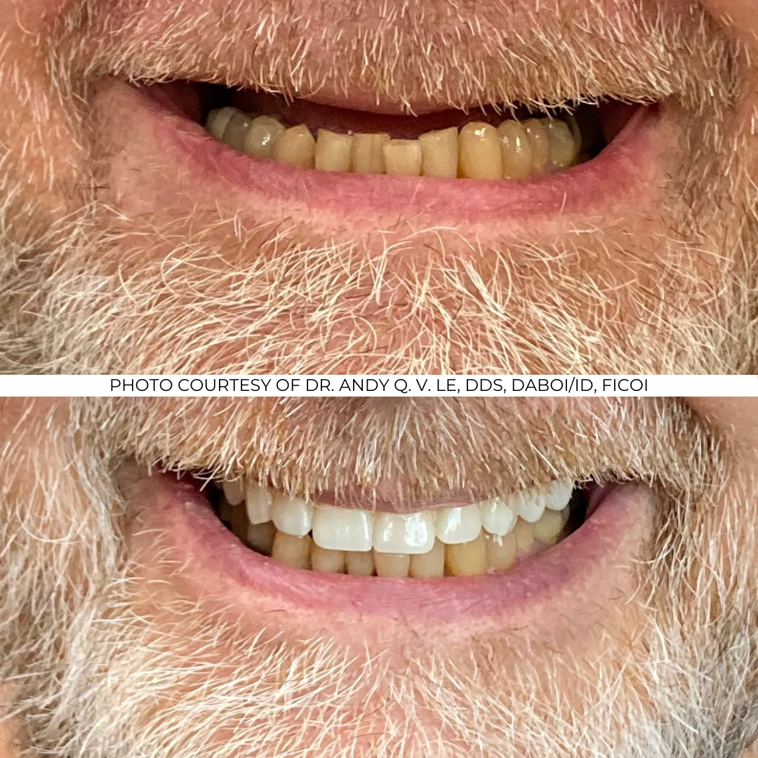 Before and After Implant Pictures